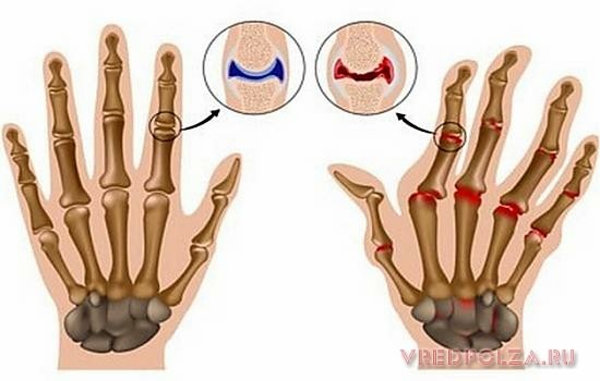 Систематический хруст пальцев приводит к хрупкости суставов, провоцирует их разбалтывание и дестабилизацию