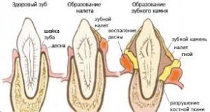 Влияние зубного камня на зубы
